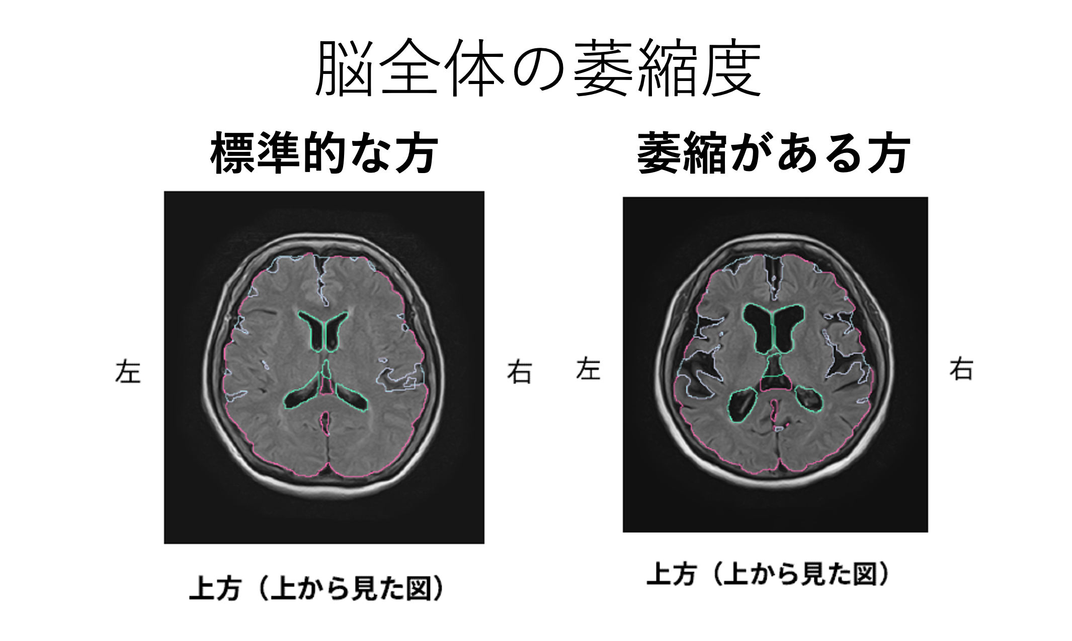 脳萎縮のイメージ
