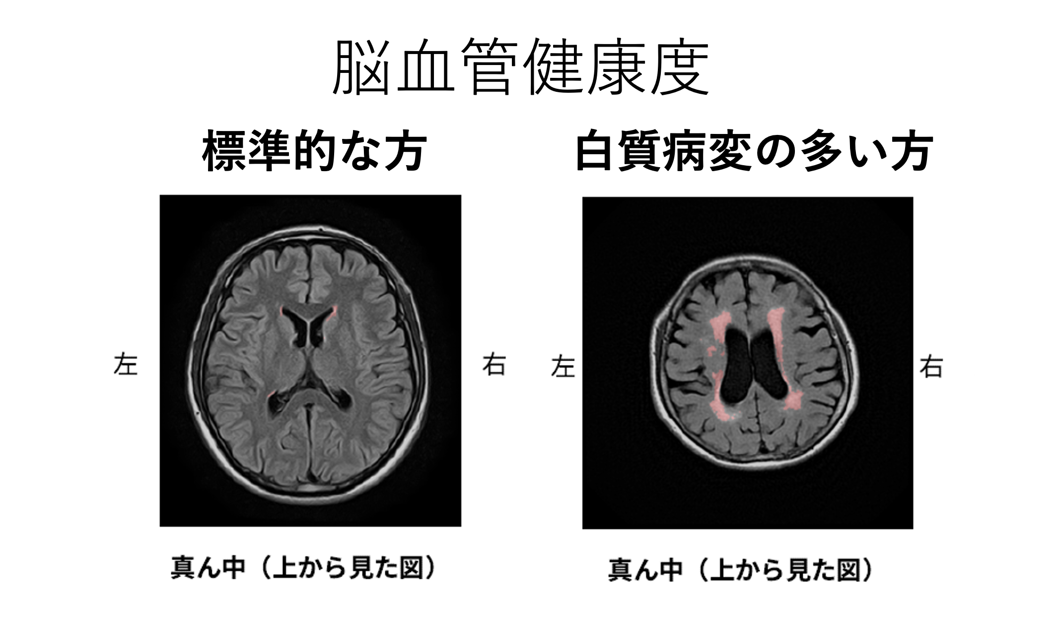 白質病変のイメージ